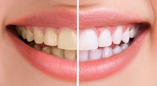 3 cong thuc tay trang rang tai nha vo cung don gian