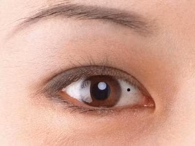 Nguoi co not ruoi o long trang mat thuong tai van kem va kho chung thuy