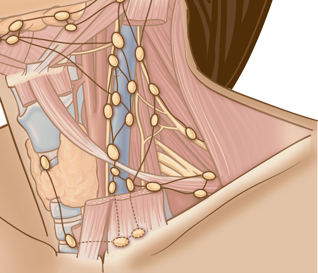 Noi hach khi nao la dau hieu cua benh ung thu?