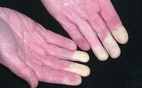 Co the ban dang mac can benh nguy hiem neu thay tay chan lanh-Hinh-2