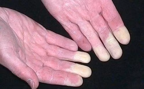 Co the ban dang mac can benh nguy hiem neu thay tay chan lanh-Hinh-2