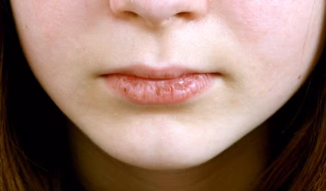 Nguoi de mac benh phu khoa thuong co 4 dac diem tren mat-Hinh-4