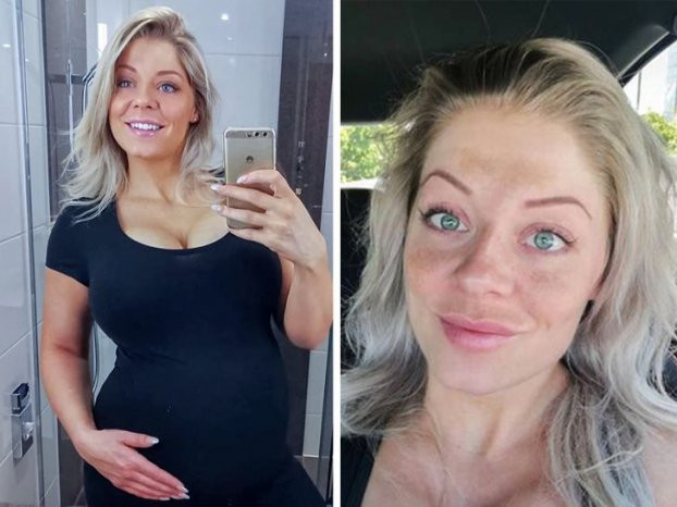 Những lý do vì sao mặt bạn xuất hiện vết thâm và cách khắc phục - Hình 7 Nhung ly do vi sao mat ban xuat hien vet tham va cach khac phuc-Hinh-7