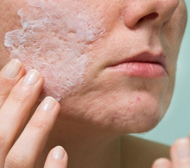 Những lý do vì sao mặt bạn xuất hiện vết thâm và cách khắc phục - Hình 6 Nhung ly do vi sao mat ban xuat hien vet tham va cach khac phuc-Hinh-6