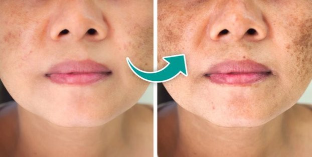 Những lý do vì sao mặt bạn xuất hiện vết thâm và cách khắc phục - Hình 2 Nhung ly do vi sao mat ban xuat hien vet tham va cach khac phuc-Hinh-2
