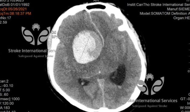 8 kieu dau dau la do benh nguy hiem, lien quan den mach mau nao