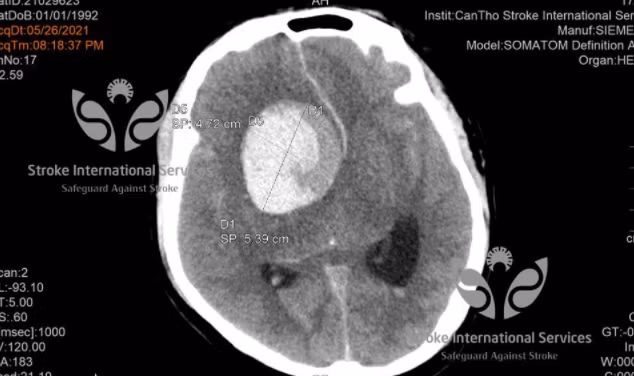 8 kieu dau dau la do benh nguy hiem, lien quan den mach mau nao