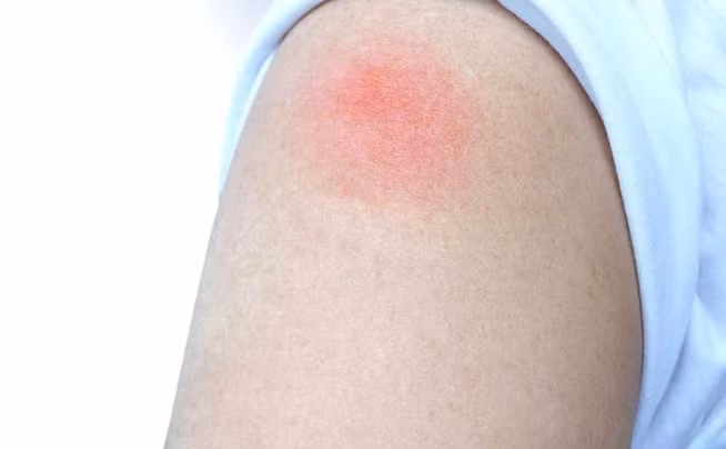 Sung dau hach bach huyet sau tiem vac xin COVID-19 co dang ngai?