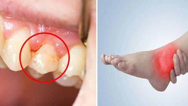 4 trieu chung khi ngu day chung to gan khong tot