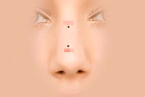 Y nghia cua not ruoi tren mui la gi?-Hinh-2