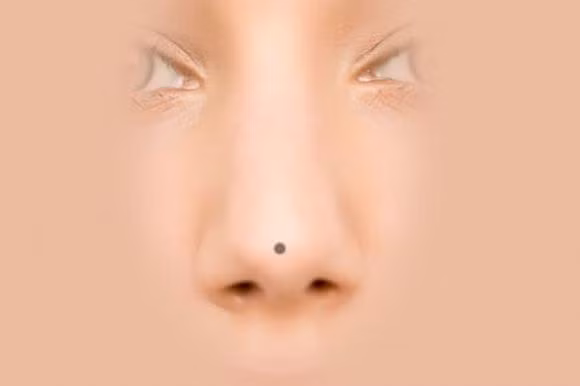 Y nghia cua not ruoi tren mui la gi?-Hinh-4