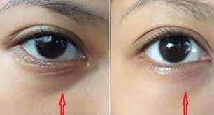 6 bieu hien tren mat canh bao chi em dang mac benh phu khoa