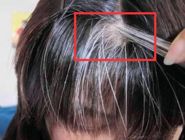 Tóc trắng mọc trên trán, thái dương và sau đầu cảnh báo điều gì? Toc trang moc tren tran, thai duong va sau dau canh bao dieu gi?