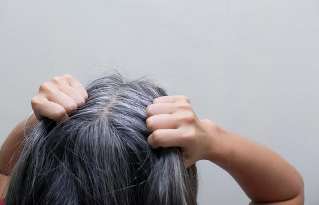 Tóc trắng mọc trên trán, thái dương và sau đầu cảnh báo điều gì? - Hình 4 Toc trang moc tren tran, thai duong va sau dau canh bao dieu gi?-Hinh-4