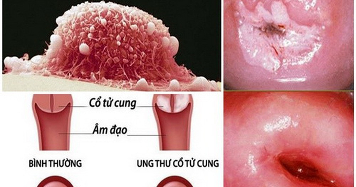 Yeu tu nam 16 tuoi khien co gai mac ung thu co tu cung