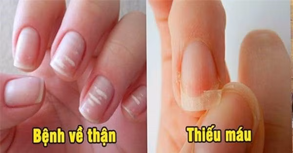 6 dau hieu o mong tay canh bao benh nguy hiem, dung chu quan-Hinh-2