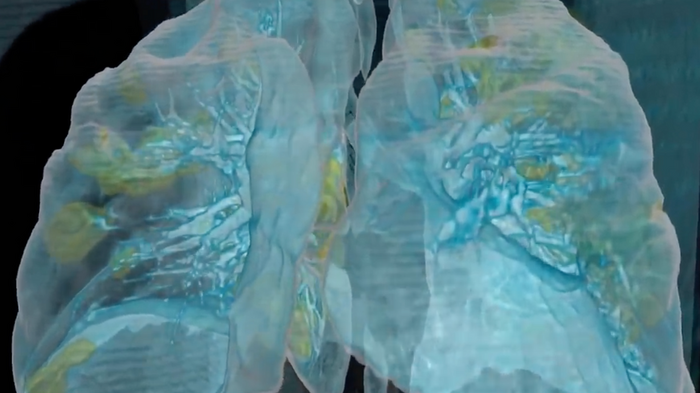 Phoi bi ton thuong do COVID-19 trong dang so the nao?