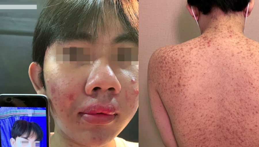 Mua silicon o cho ve tiem, ca xom bien chung nang mot nguoi tu vong