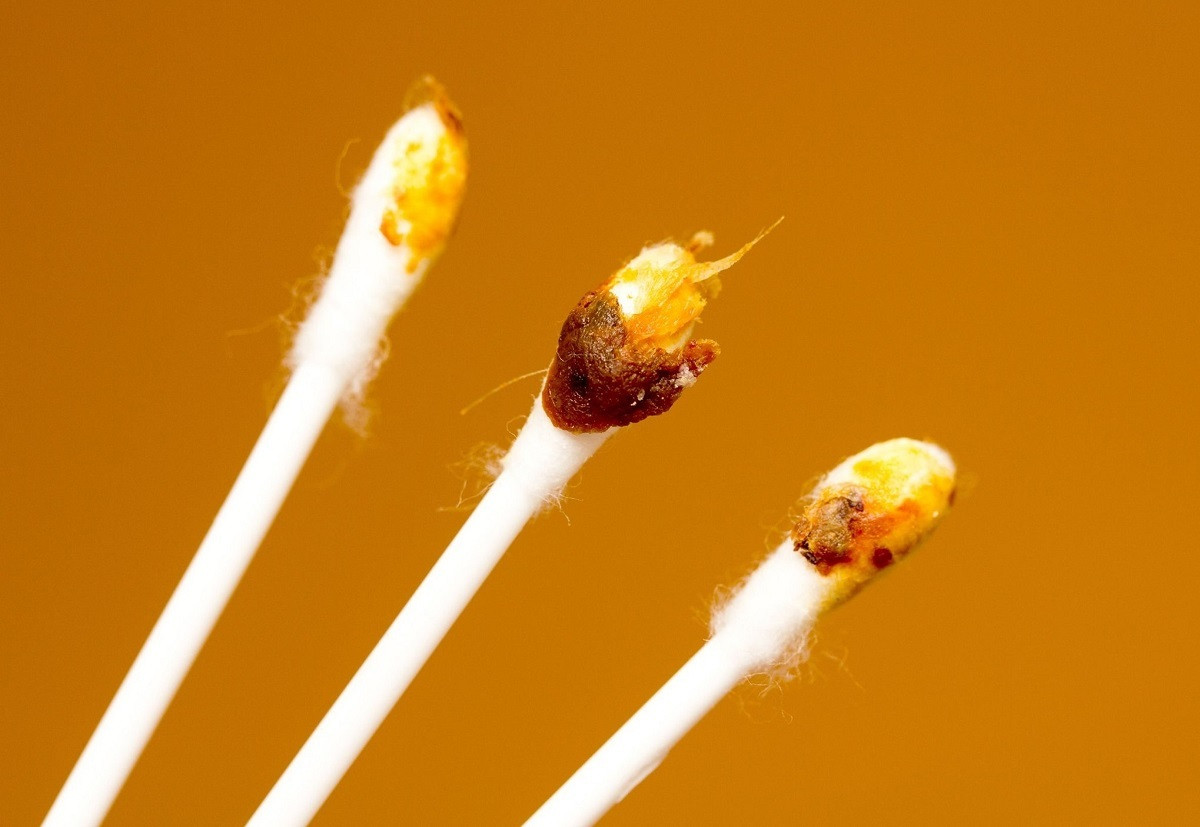 Màu ráy tai tiết lộ tình trạng sức khỏe của bạn ảnh 1