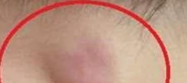 Mot so trieu chung co the la ve benh ung thu ma ban nen biet