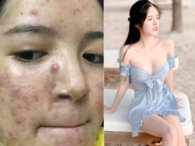 Cô gái mặt chi chít mụn lột xác 180 độ, xinh đẹp như thiên thần Co gai mat chi chit mun lot xac 180 do, xinh dep nhu thien than