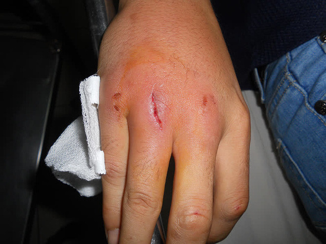 4 dấu hiệu trên bàn tay cảnh báo đường huyết cao - Hình 3 4 dau hieu tren ban tay canh bao duong huyet cao-Hinh-3