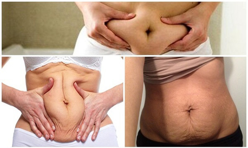 Khắc phục tình trạng da bụng bị chảy xệ, nhăn nheo ảnh 1