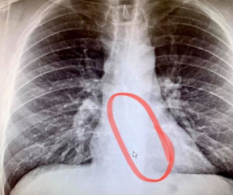 Nguoi dan ong nuot AirPods khi ngu