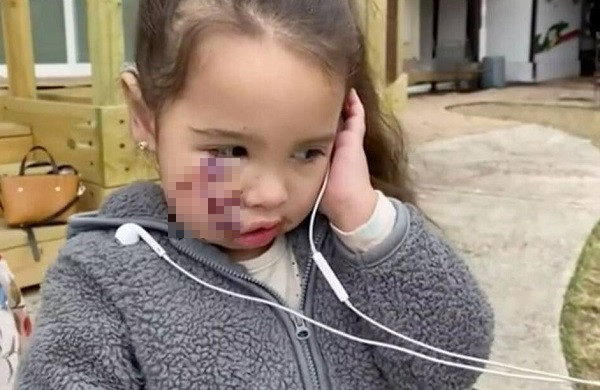 Cau noi cua be gai 3 tuoi sau tran tan cong cua cho pit bull