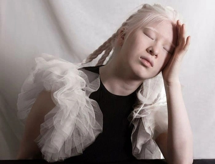 Sinh ra với căn bệnh bạch tạng, Xueli bị cha mẹ ruột bỏ bên ngoài một trại trẻ mồ côi ở Trung Quốc. Tại quê hương cô, nhiều người vẫn coi đứa trẻ sinh ra với làn da, mái tóc trắng muốt là kẻ bị nguyền rủa, đem lại điều xui. Ở một số địa phương, những người mắc bệnh bạch tạng thường chịu sự kỳ thị, phân biệt đối xử.