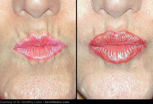 Trước và sau khi dùng chất độn thẩm mỹ cho môi: Nhiều chất độn thẩm mỹ điều trị nếp nhăn và quầng thâm cũng có thể làm đầy môi. Tiêm collagen và axit hyaluronic có tác dụng tạm thời. Tiêm môi bằng các tế bào chất béo đôi khi đạt được kết quả lâu dài.