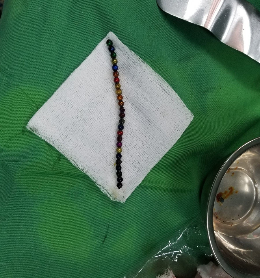 Bé trai 3 tuổi nuốt 25 viên bi nam châm vào bụng ảnh 2