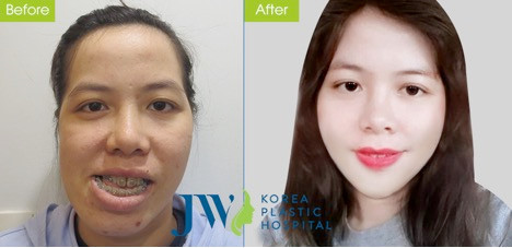 Co giao Binh Dinh thay doi dien mao sau phau thuat chinh ham-Hinh-2