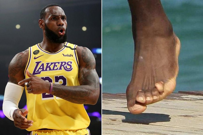 Ngón chân biến dạng của các VĐV bóng rổ Ngon chan bien dang cua cac VDV bong ro