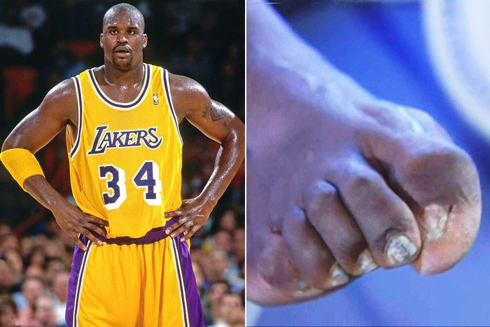 Shaq O'Neal có bàn chân khổng lồ với kích cỡ giày là 22 theo chuẩn Mỹ, tức 57 ở Việt Nam. Ông còn gây chú ý với ngón chân cái biến dạng. Tuy nhiên, Shaq khá thoải mái với điều này khi thường xuyên khoe bàn chân của mình lên mạng xã hội.