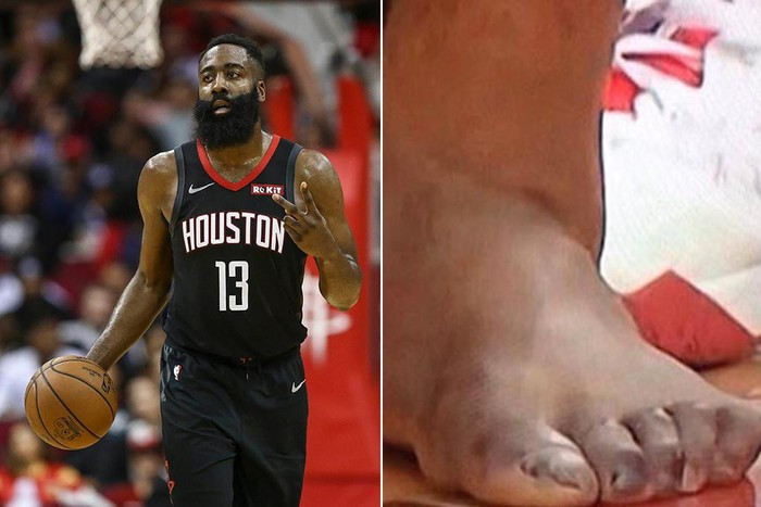 James Harden từng để lộ những ngón chân biến dạng trong thời gian khởi động trước một trận đấu bóng rổ vào năm 2013. "Bàn chân trái của anh ấy trông như vừa trải qua trận đấu dài 10 hiệp với Floyd Mayweather", Bleacher Report hóm hỉnh nhận xét về những ngón chân của Harden.