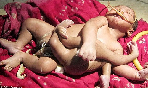 Cậu bé sơ sinh có 4 chân, 4 tay, được xem như hiện thân của vị thần Hindu.