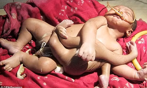 Cậu bé sơ sinh có 4 chân, 4 tay, được xem như hiện thân của vị thần Hindu.