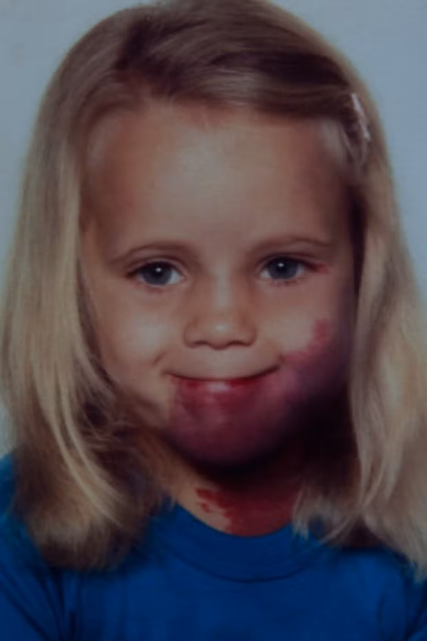 Tâm sự đau đớn của người phụ nữ sinh ra với vết chàm khổng lồ: Nó đã hủy hoại tuổi thơ của tôi!-1