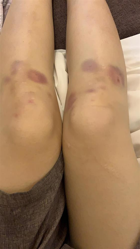 Chia sẻ hình ảnh "tả tơi" và đôi chân bầm lên trang cá nhân, Thúy Ngân khiến fan xót xa. Tuy nhiên cô nàng lại vô cùng vui vẻ với những "chiến tích" của mình. "Chơi là phải chơi bầm mình, à nhầm hết mình", người đẹp viết.