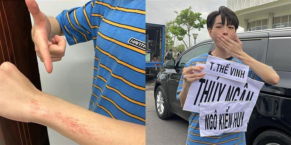 Nam ca sĩ tươi rói chụp ảnh cùng bảng tên của mình cùng với bảng tên 3 thành viên Trương Thế Vinh - Thúy Ngân - Ngô Kiến Huy. Thế nhưng không ít người hâm mộ xót xa khi thấy giọng ca sinh năm 1996 rướm máu hết cả tay, trầy cả mặt.