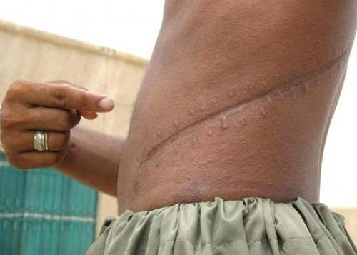 Người bán thận được "nuôi dưỡng" trong khách sạn. Sau đó họ bị bịt mắt dẫn đến bệnh viện để cắt thận. Ảnh minh họa: Blogspot.