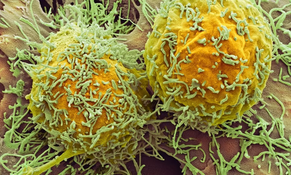 3 yeu to gay gia tang so ca ung thu gan