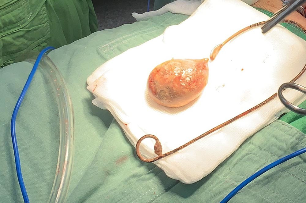 Cu ba quen ong sonde 9 nam trong bung, soi bam to nhu qua trung