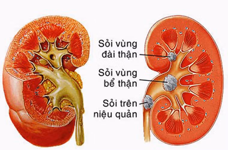 Khi cơ thể được cung cấp một lượng nước nhỏ, thành phần canxi sẽ có cơ hội kết hợp với muối và các khoáng chất khác hình thành nên sỏi thận.