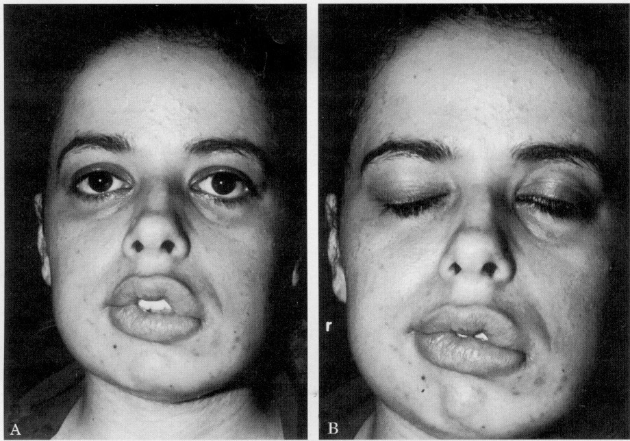 Kinh hoang can benh khien nguoi mac mang 