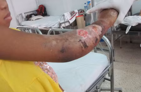 Theo mô tả, vết thương do ngải ăn thịt gây ra sẽ giống như vết bỏng.