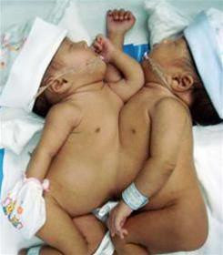 Năm 2007, tại Thái Lan cũng đã xuất hiện một cặp song sinh dính liên ngực và bụng là 2 bé gái có tên Panwad và Pantawan.