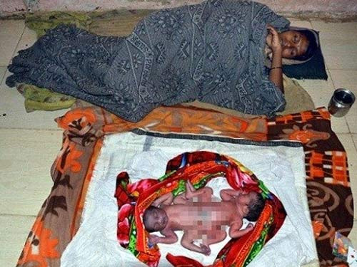 Trước đó, cũng tại Ấn Độ, một phụ nữ đã hạ sinh một cặp sinh đôi là hai bé gái. Điều đáng nói là hai em bé này bị dính liền phần thân dưới và được sinh hoàn toàn tự nhiên tại nhà. Tuy nhiên sau đó, hai bé gái đã được chuyển đến bệnh viện Wadia, ngay sau đó, các bác sĩ tại bệnh viện này cho biết: “Một trong hai bé đang trong tình trạng rất nguy kịch, khó thở. Chúng tôi có thể không cứu được tính mạng của cả hai bé”.