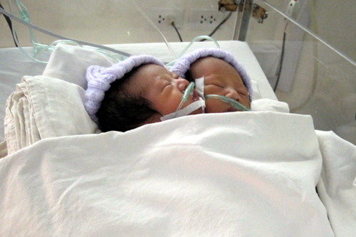 Ở Việt Nam, năm 2011 tại Bệnh viện Nhi Đồng 1, cũng đã từng tiếp nhận một sản phụ sinh ra cặp song sinh dính liền nhưng không hoàn chỉnh. Đó là sản phụ Lâm Thị Mỹ Dân, 32 tuổi, ngụ ấp Sàn Long, xã An Ninh, huyện Châu Thành, tỉnh Sóc Trăng.